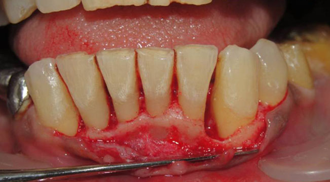 вот так выглядит болезнь полости рта - парадонтит